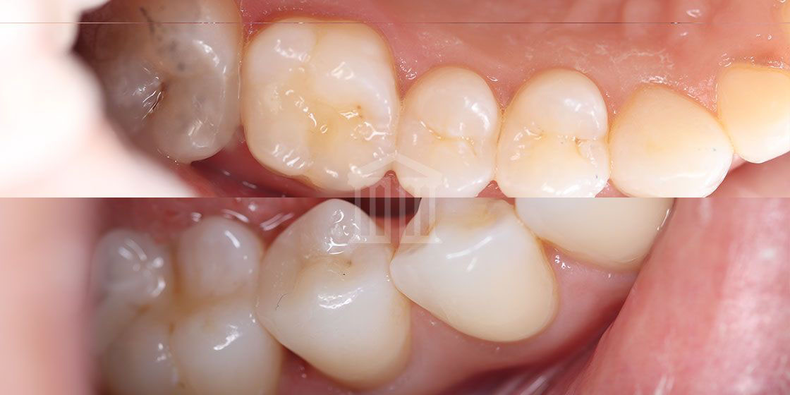 Close-up of upper and lower back teeth with tooth-coloured composite fillings visible on the molar surfaces
