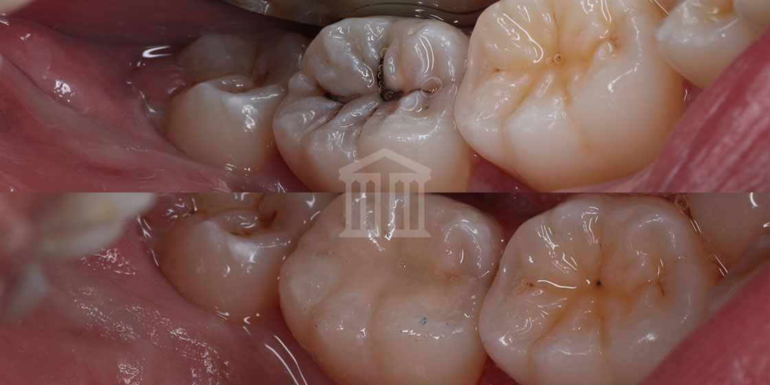 Close-up before and after comparison of molar teeth showing decay treated with tooth-coloured composite fillings