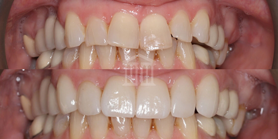 Before and after dental crowns treatment showing stained, uneven teeth transformed into uniform, whiter teeth