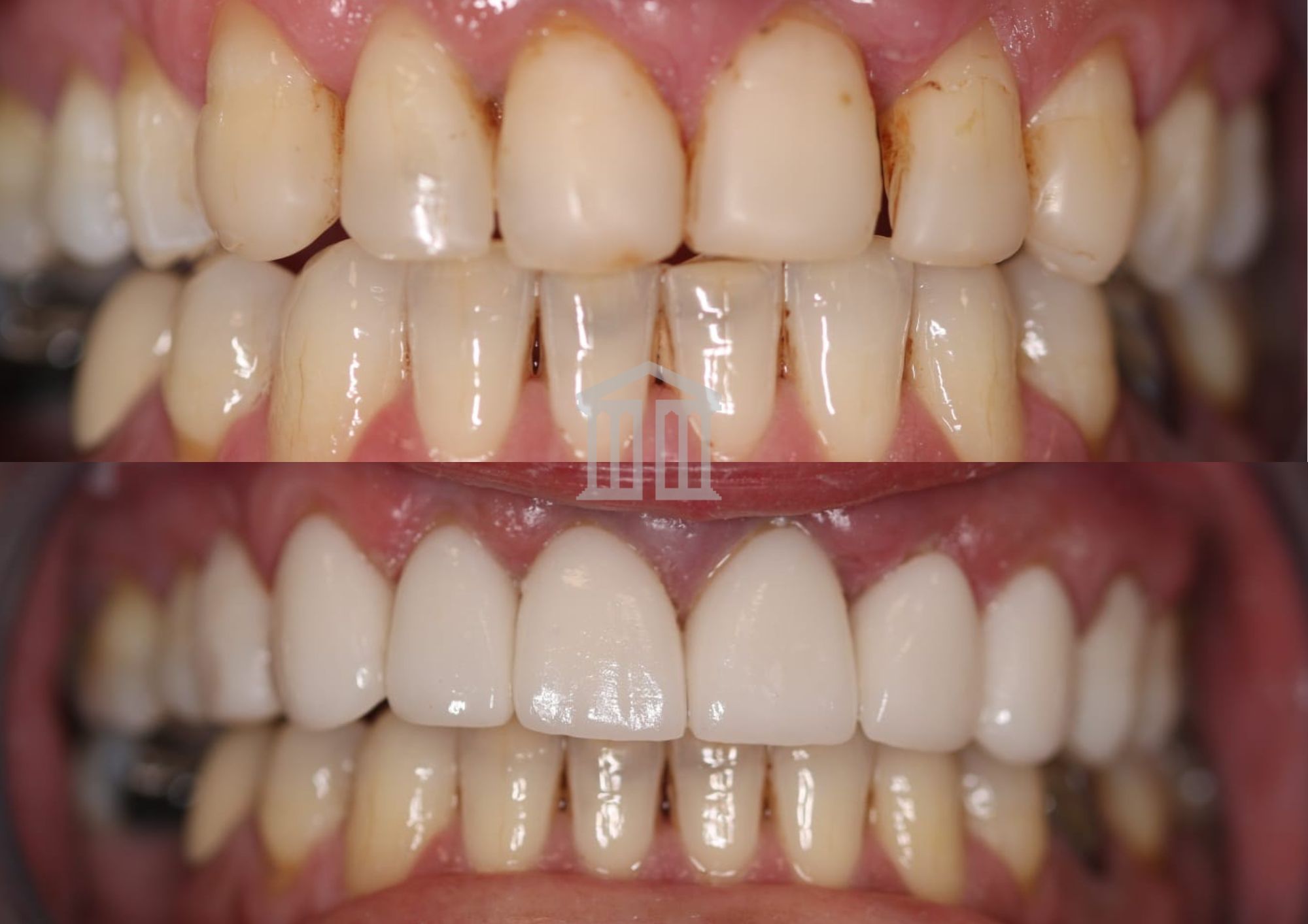 Before (top) and after (bottom) showing upper teeth restored from discoloured, worn dentition to uniform white dentures
