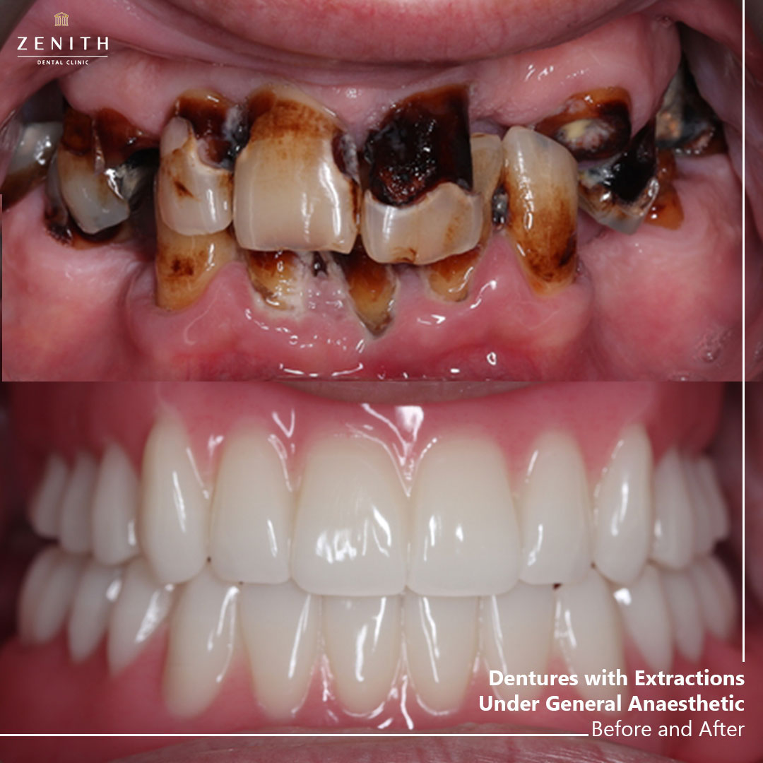 Before (top) and after (bottom) showing Zenith Dental Clinic dentures with extractions under general anaesthetic, replacing severely decayed teeth.