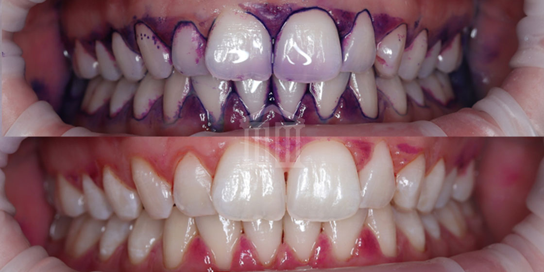 Close-up before and after comparison of teeth following a scale and polish, showing plaque disclosing dye then clean teeth