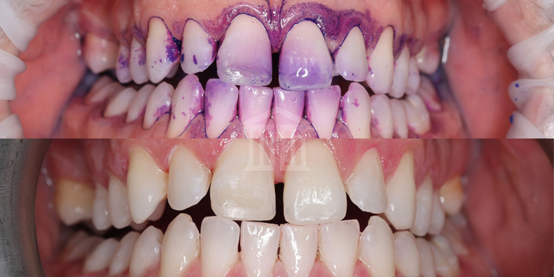 Close-up before and after dental scale and polish, showing plaque-stained teeth above and clean, white teeth below.