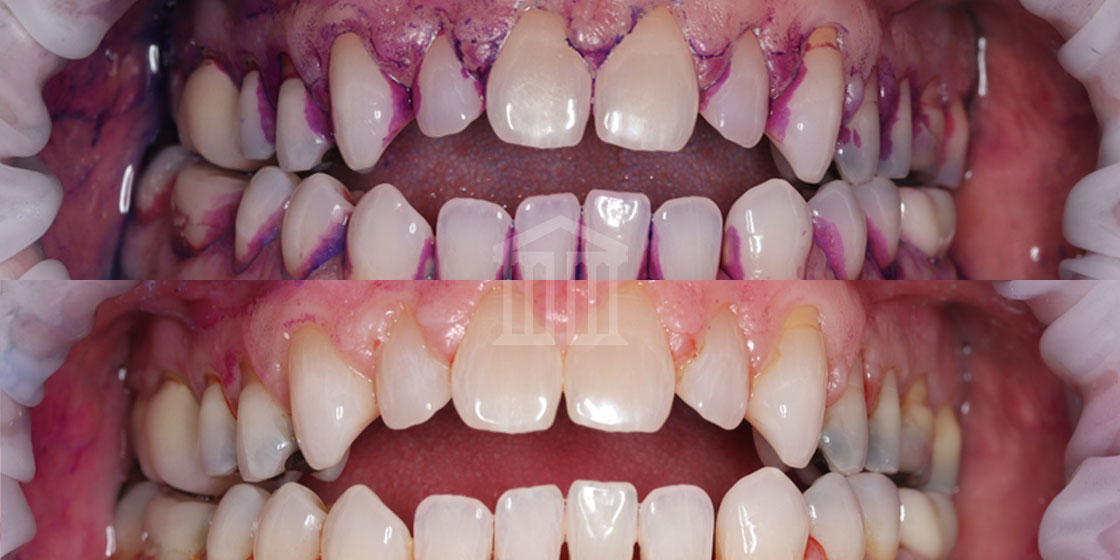 Close-up before and after comparison of teeth showing plaque-stained gums above and cleaner teeth with healthier gums below after a scale and polish.