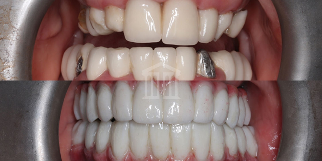 Before and after dental implants showing stained teeth with metal fillings replaced by a full set of bright white uniform teeth