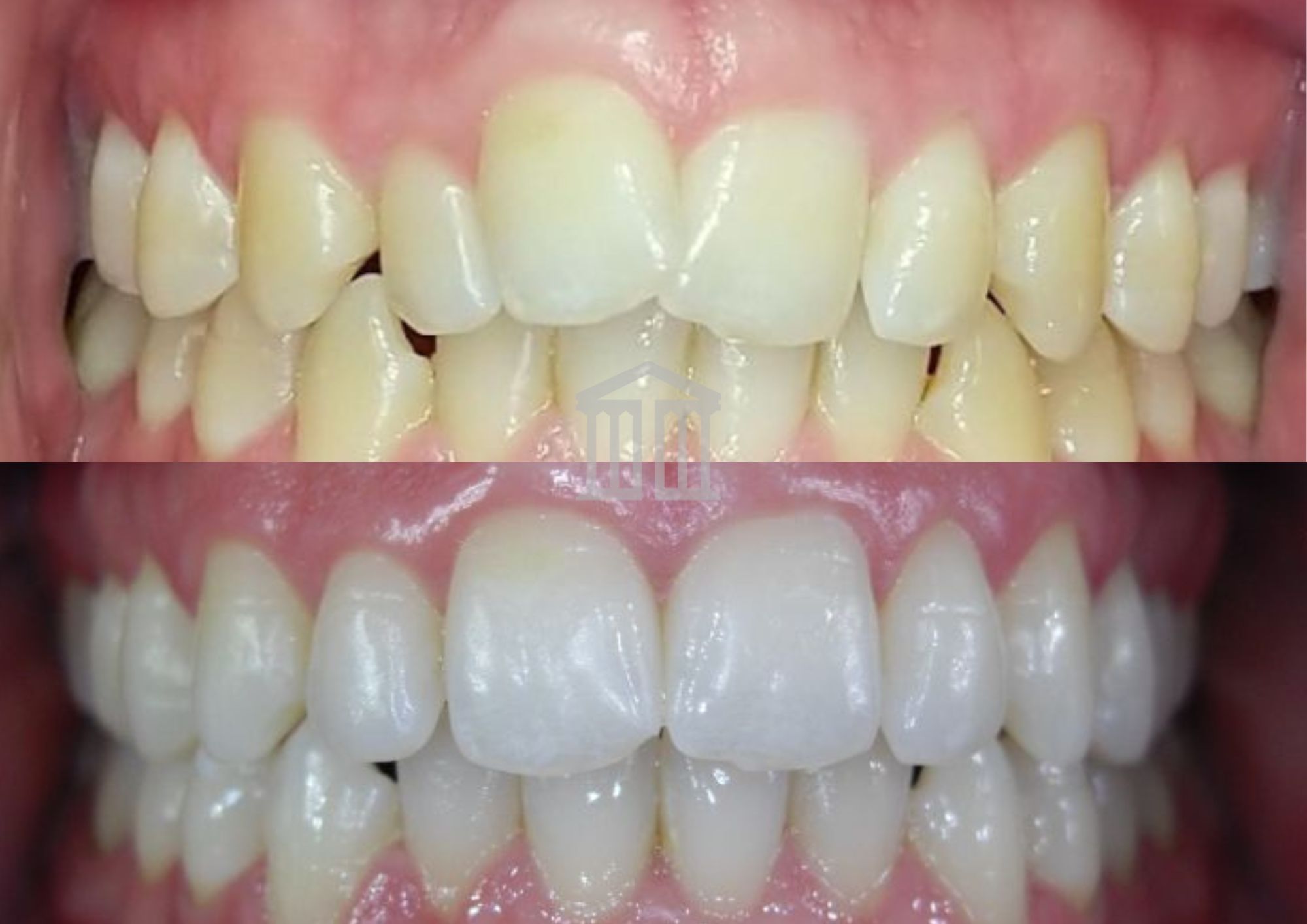 Before (top) and after (bottom) showing teeth straightened and whitened, with crowding and discolouration visibly reduced.