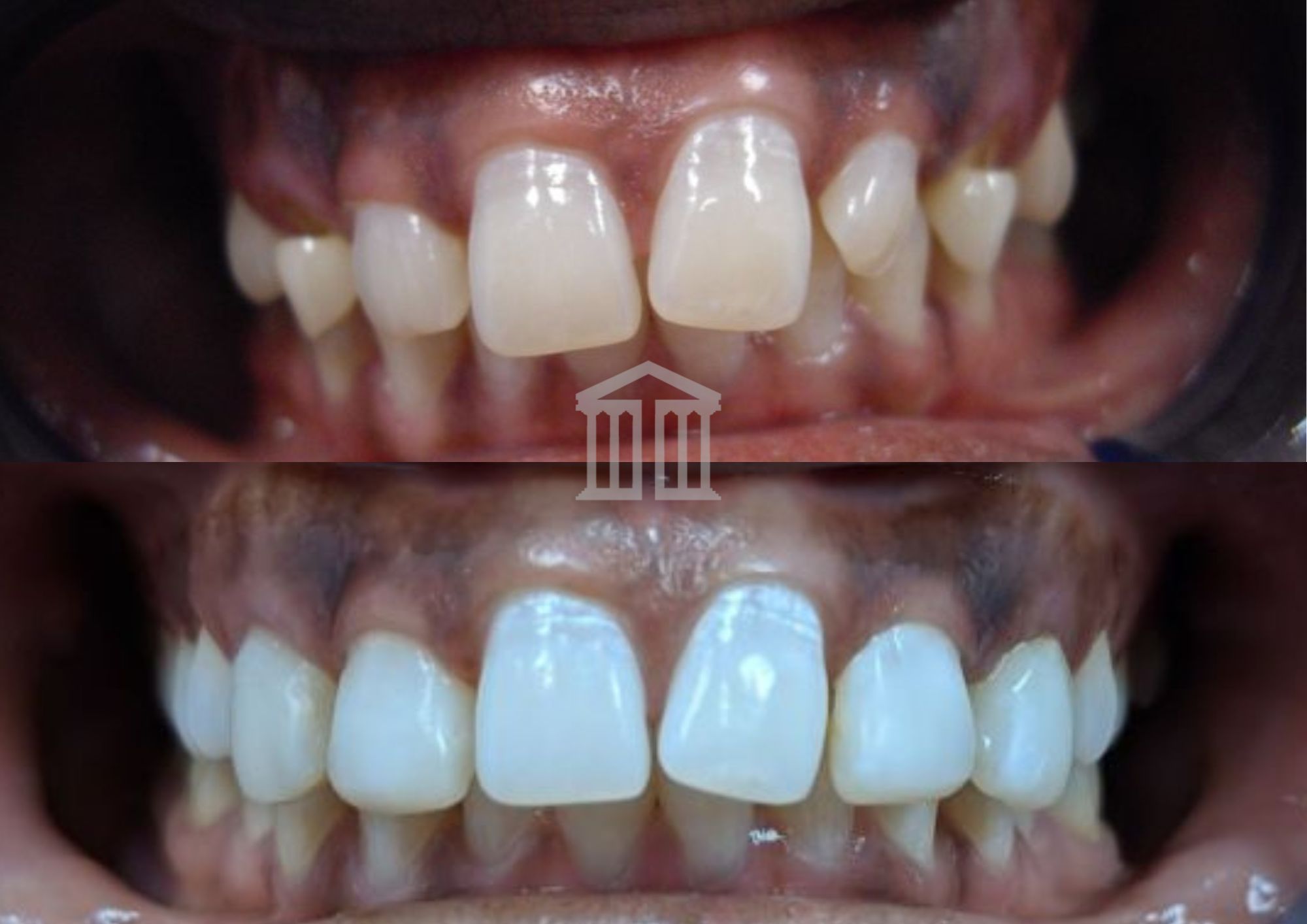 Before (top) and after (bottom) showing upper teeth straightened and whitened following Invisalign treatment at Zenith Cosmetic Dental.