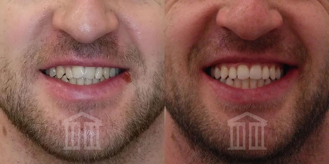 Before and after showing straighter, more evenly spaced teeth following Invisalign treatment at Zenith Cosmetic Dental.