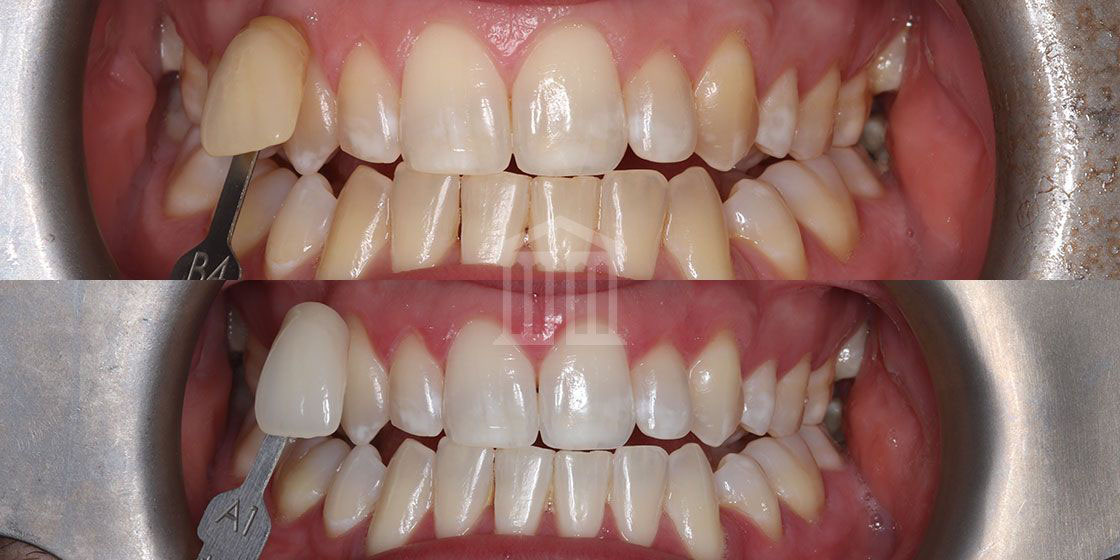 Before (top) and after (bottom) showing teeth whitening result, with shade guide comparing yellow B4 to bright white A1.