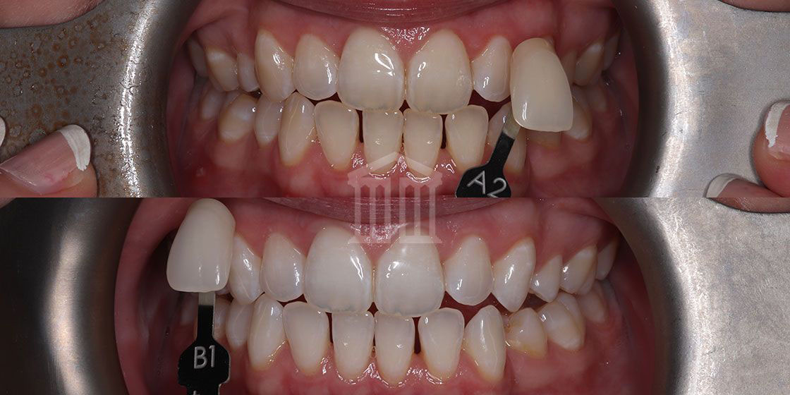 Before (top) and after (bottom) teeth whitening, shade guide showing A2 before and B1 after treatment.