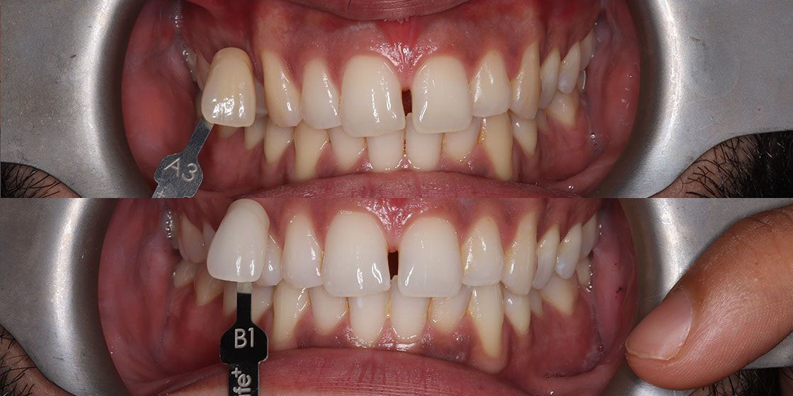 Before and after teeth whitening comparison showing shade guide A3 versus B1, with visibly brighter, whiter teeth post-treatment