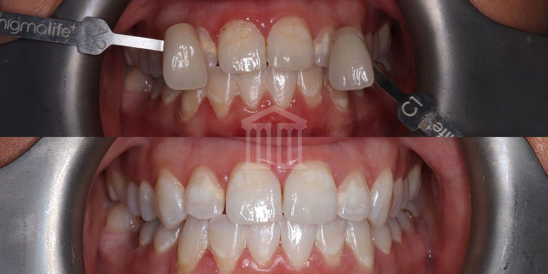 Before (top) and after (bottom) teeth whitening, showing upper front teeth matched against a shade guide, then visibly whiter results.