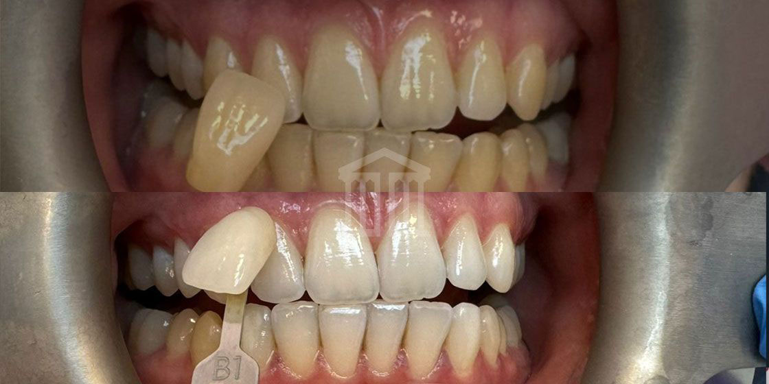 Close up of teeth being shade matched against a B1 colour guide before and after whitening treatment