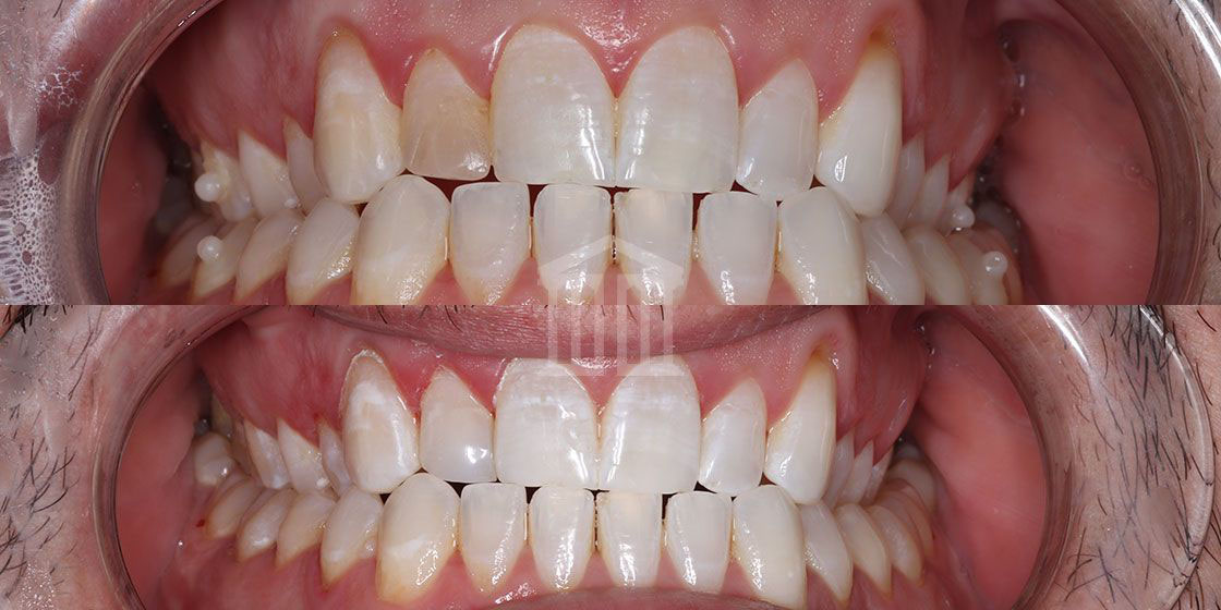 Before (top) and after (bottom) showing teeth whitening results with reduced yellowing across upper and lower teeth.