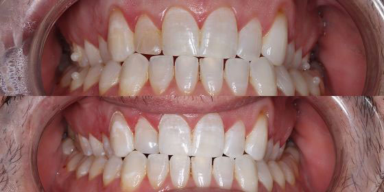 Before and after teeth whitening treatment showing visibly brighter, whiter teeth in the lower panel