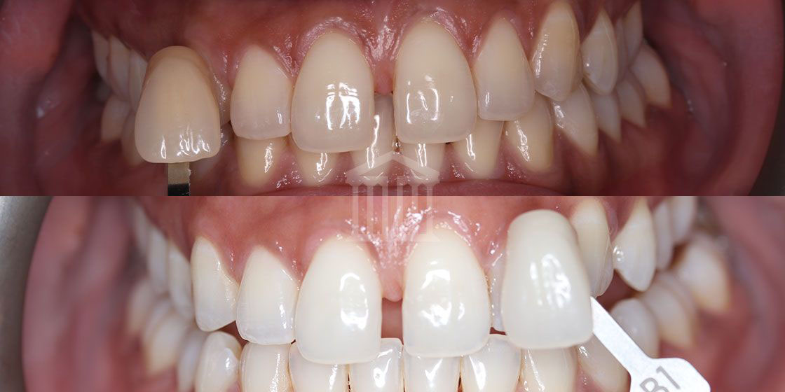 Before (top) and after (bottom) showing teeth whitened to a brighter, whiter shade, with a B1 shade guide visible.