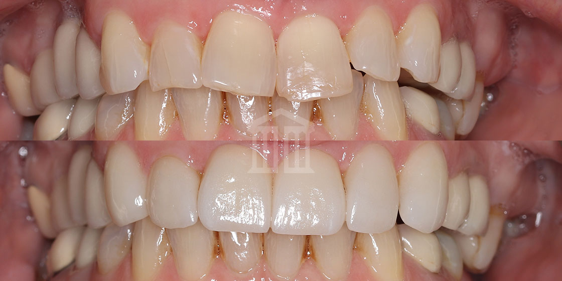 Before (top) and after (bottom) showing upper front teeth transformed from uneven, yellowed teeth to uniform, bright white veneers.