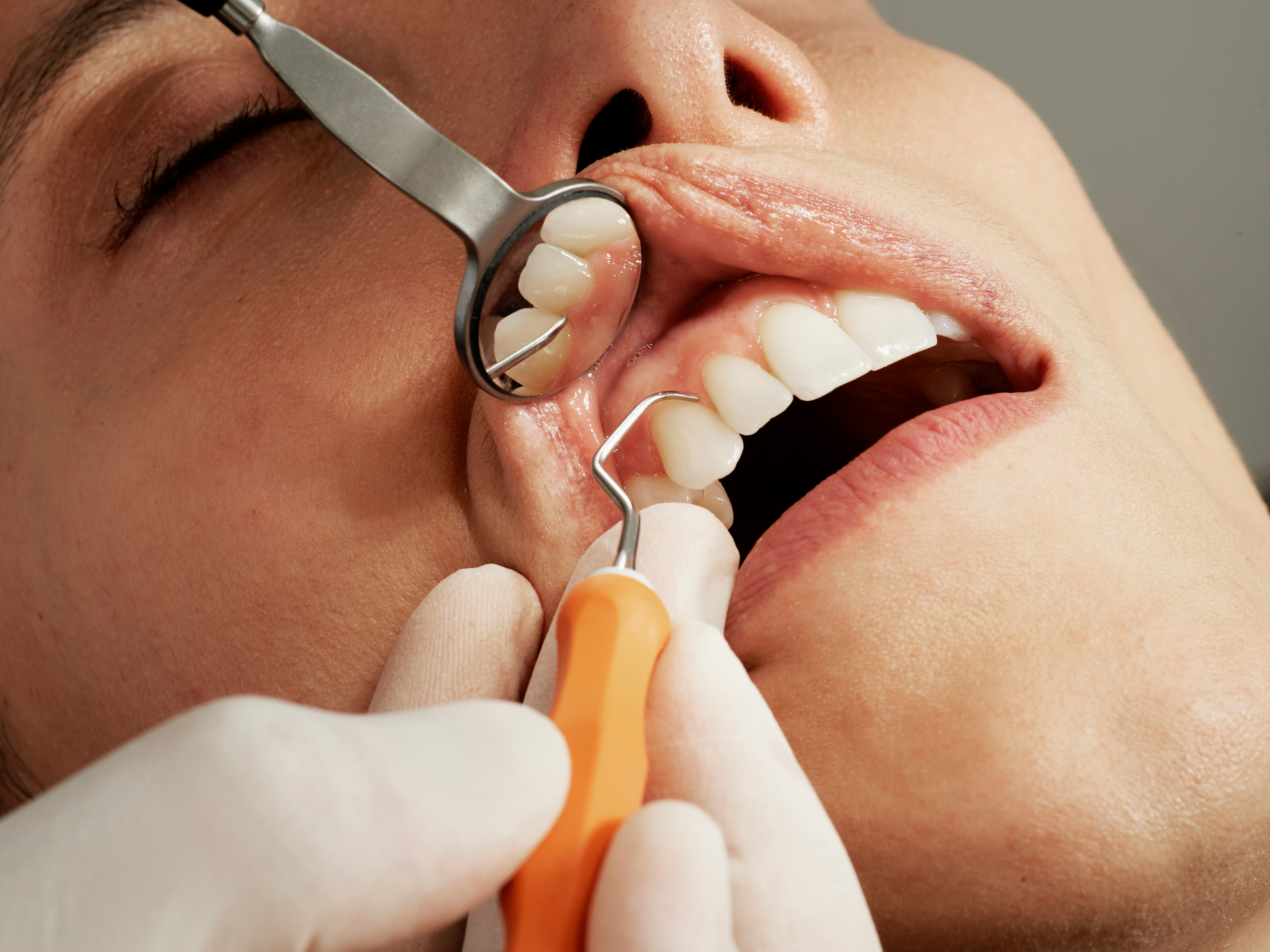 Close-up of a dentist in gloved hands using a dental mirror and scaler to examine a patient's teeth during a dental examination.
