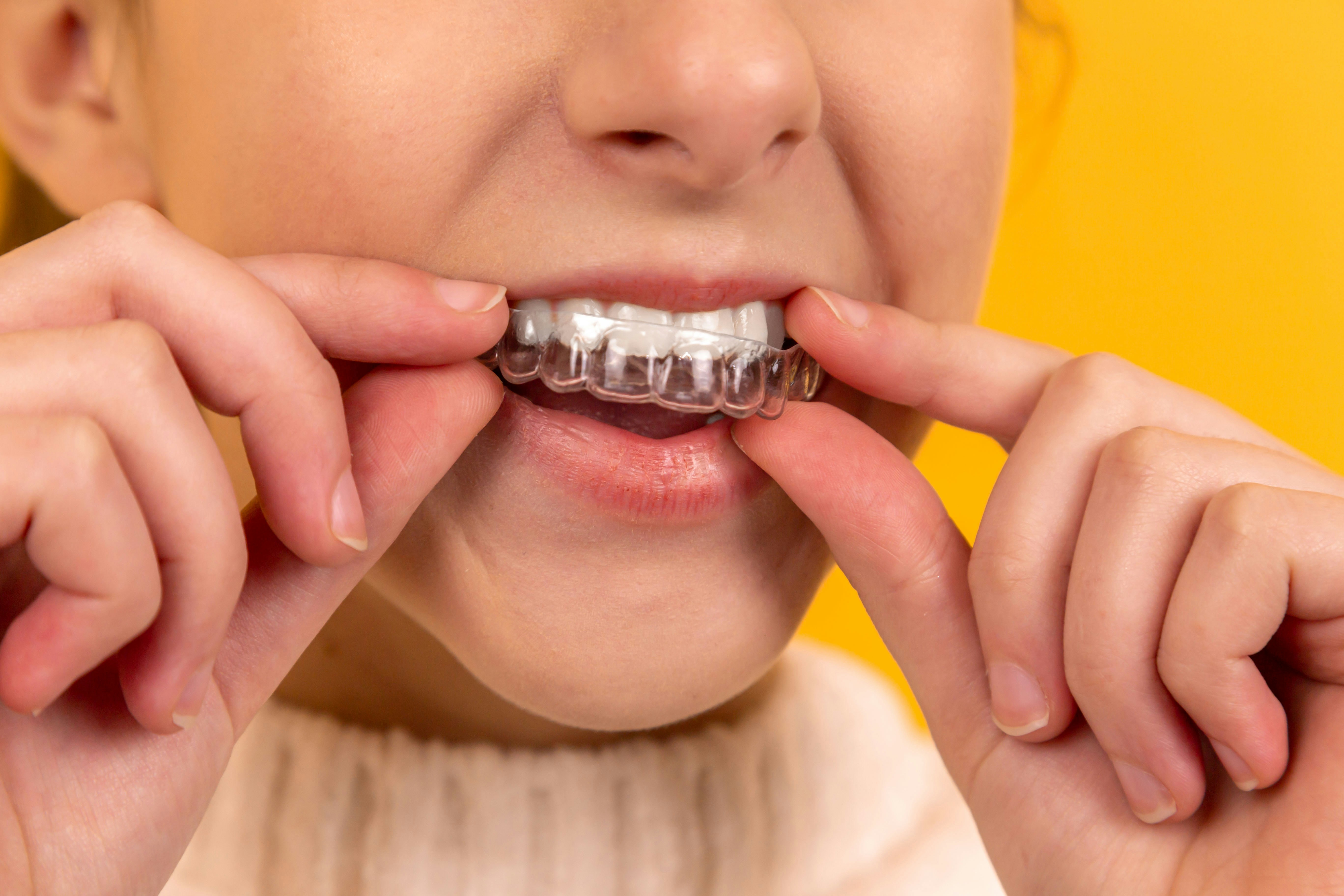 Person fitting a clear dental aligner over their upper teeth using both hands against a yellow background