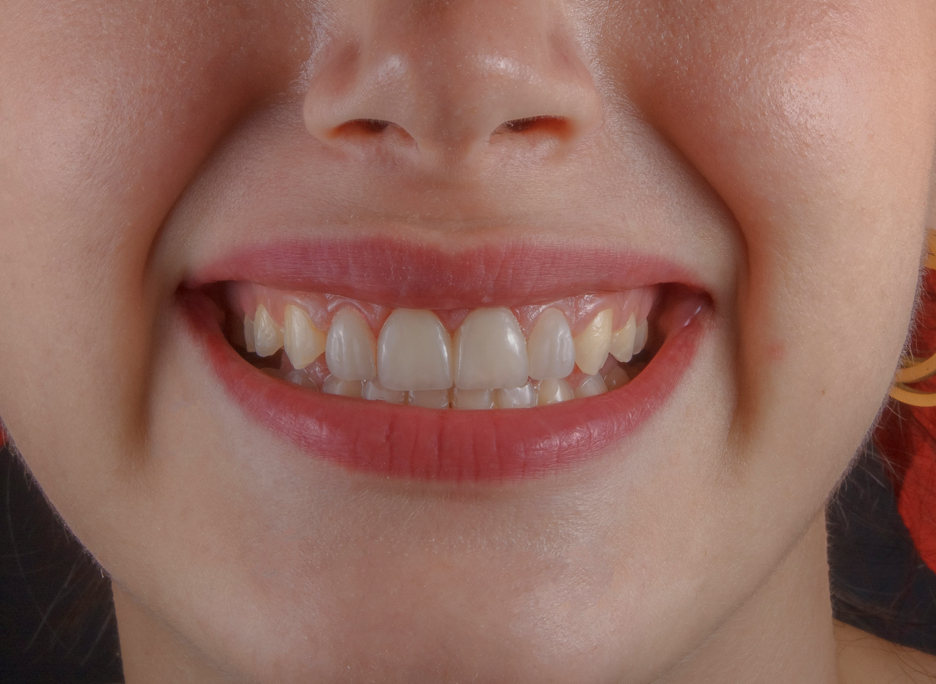Close-up of a woman smiling, showing her upper and lower teeth with slight natural discolouration