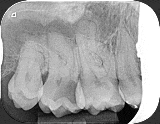X-ray image from Zenith Cosmetic Dental before tooth extraction