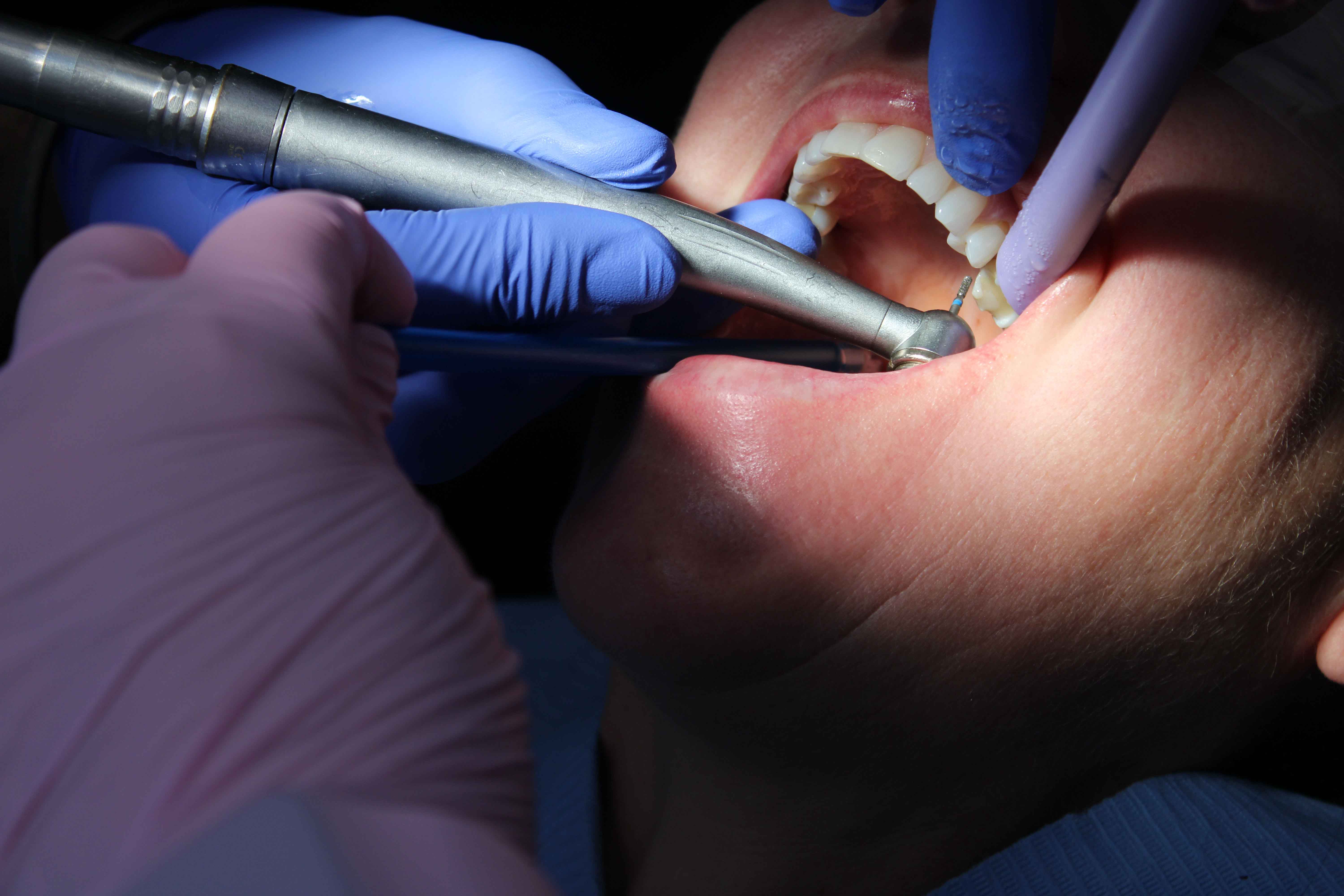 Dentist in blue gloves using a dental handpiece drill on a patient's chipped teeth during treatment