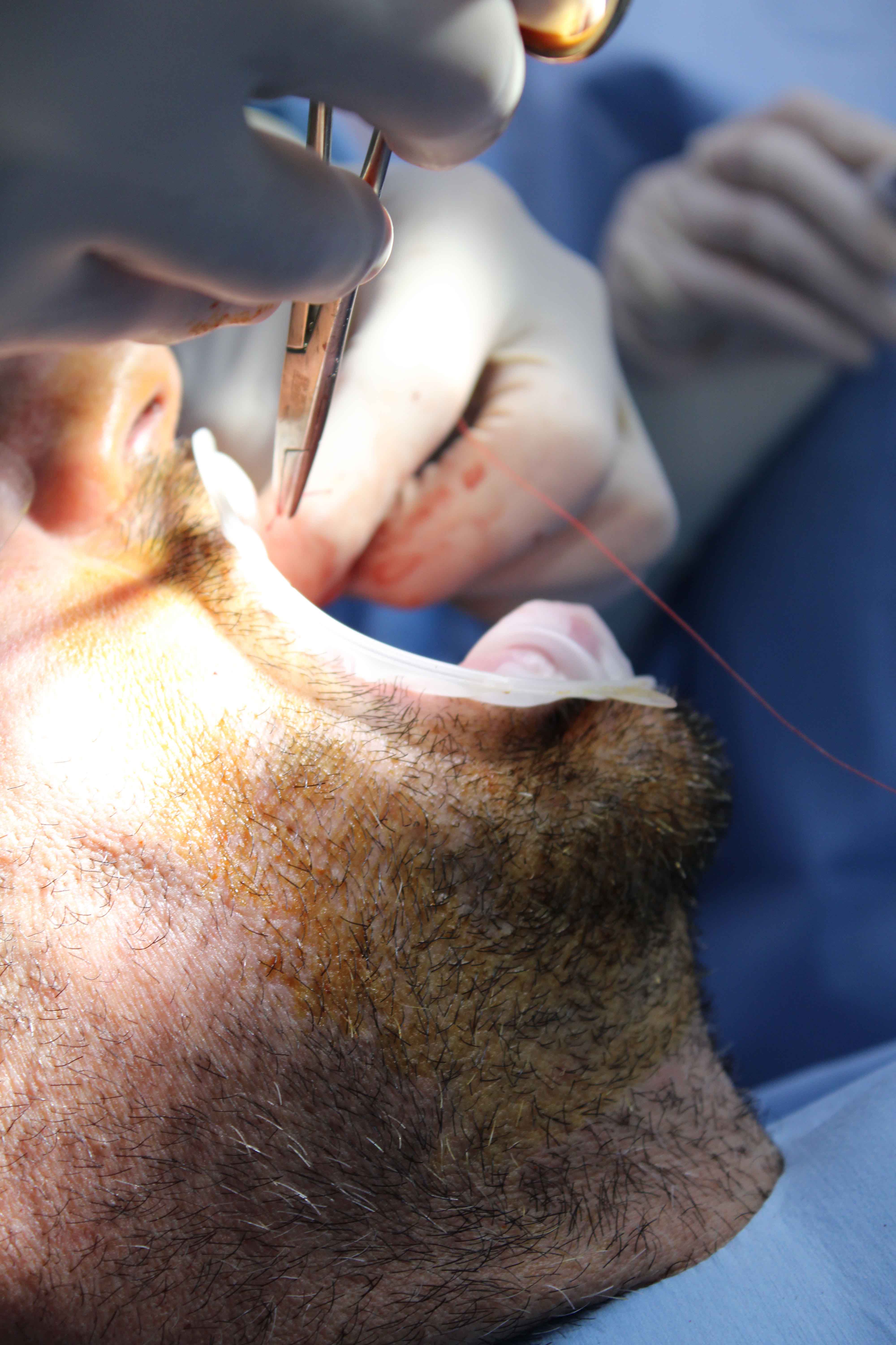 Gloved hands using surgical forceps and suture thread on a male patient's mouth during a dental surgical procedure