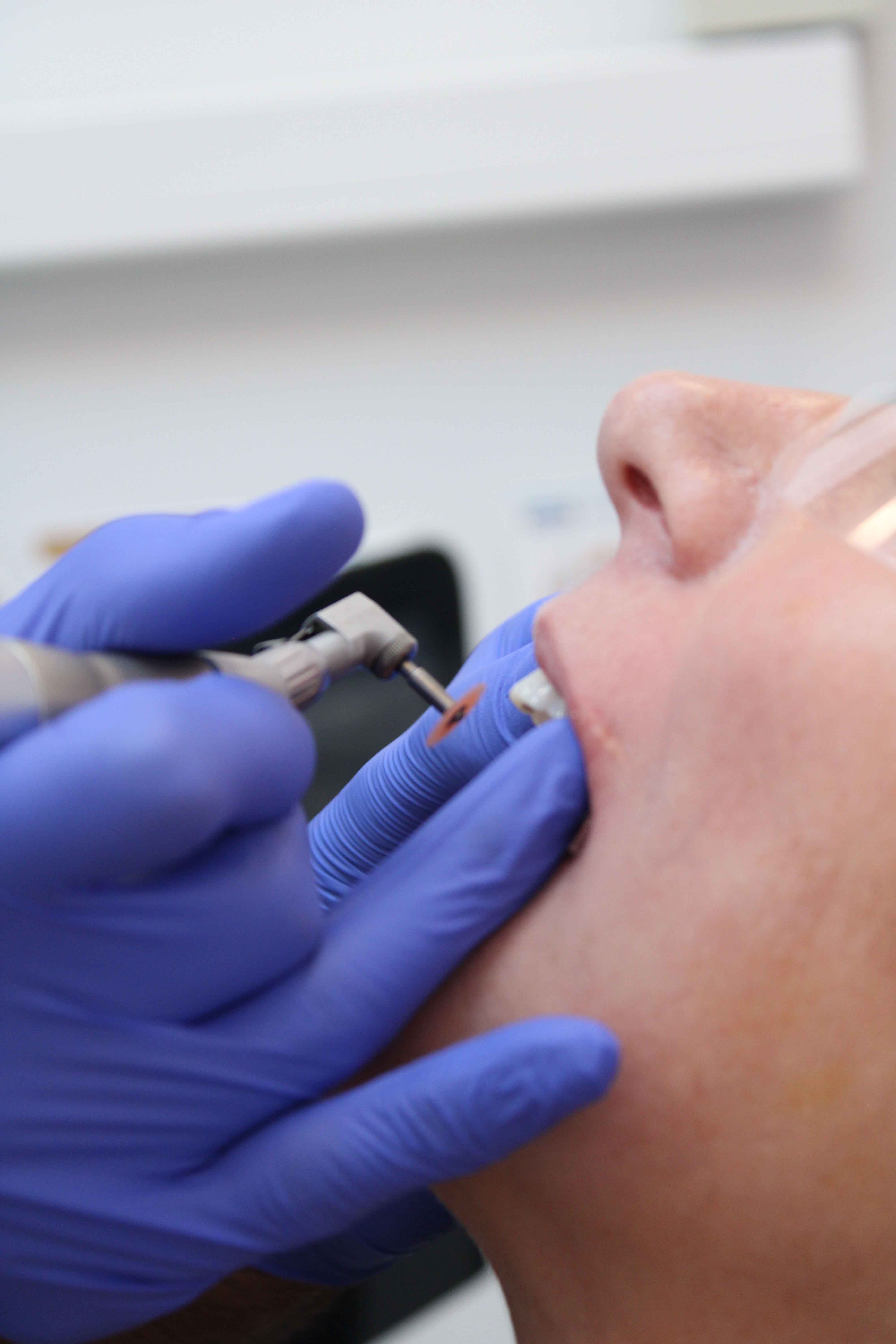 Dentist in blue latex gloves using a rotary polishing tool inside a patient's open mouth
