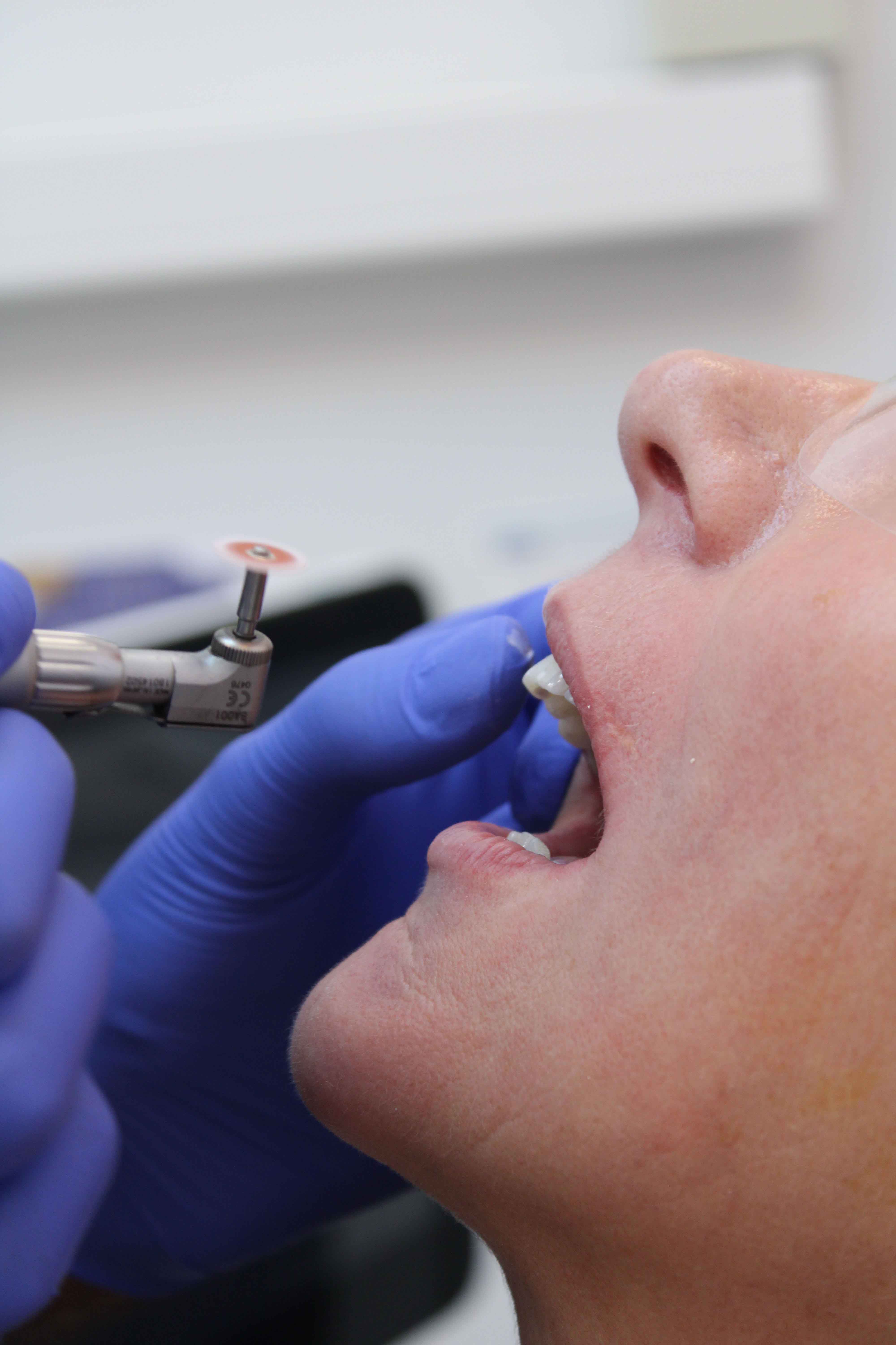 Dentist in blue gloves using a rotary dental tool on a patient's open mouth with visible teeth gaps