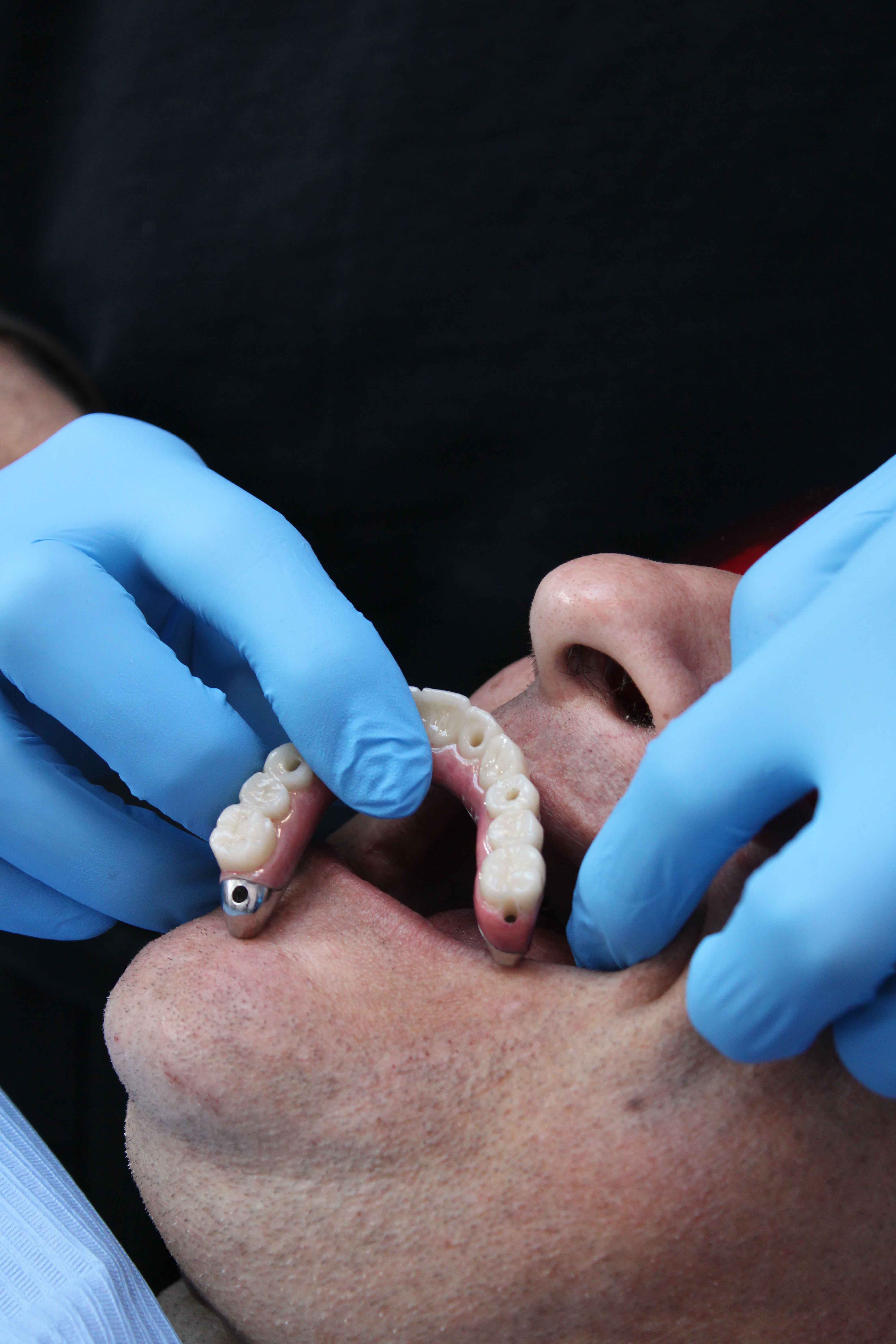 A gloved dentist fitting an All-on-4 dental implant bridge into a patient's open mouth.