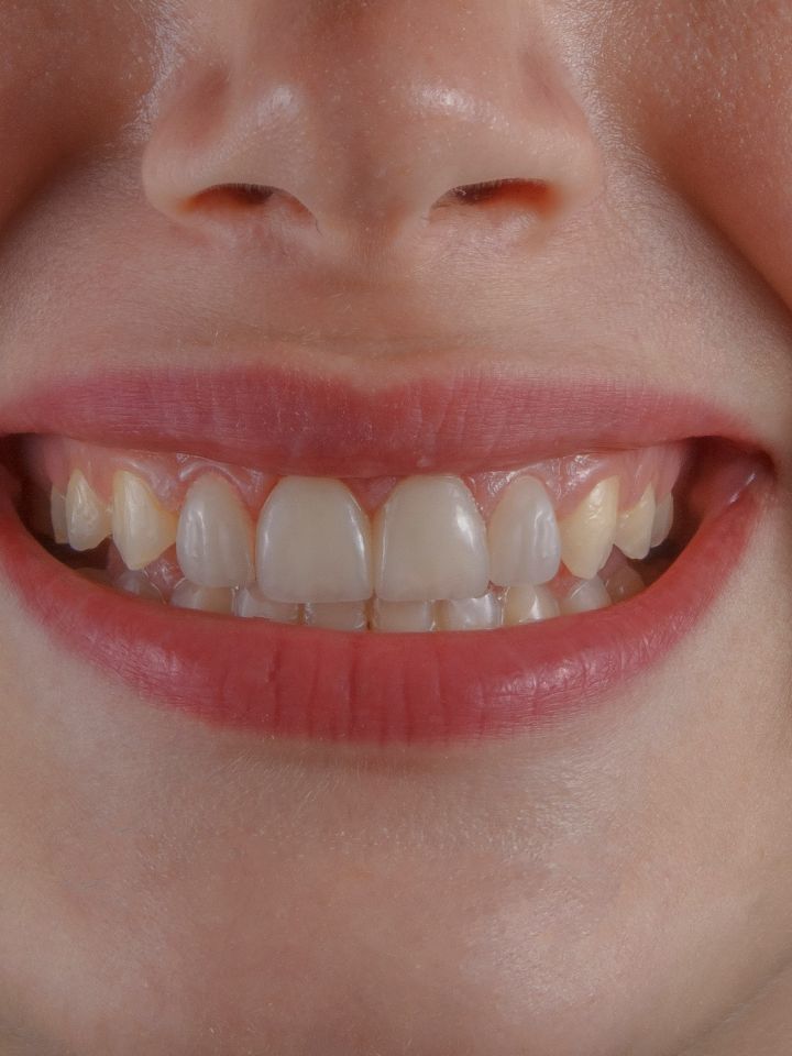 Close up of a person smiling, showing upper teeth with some yellowing at the edges.
