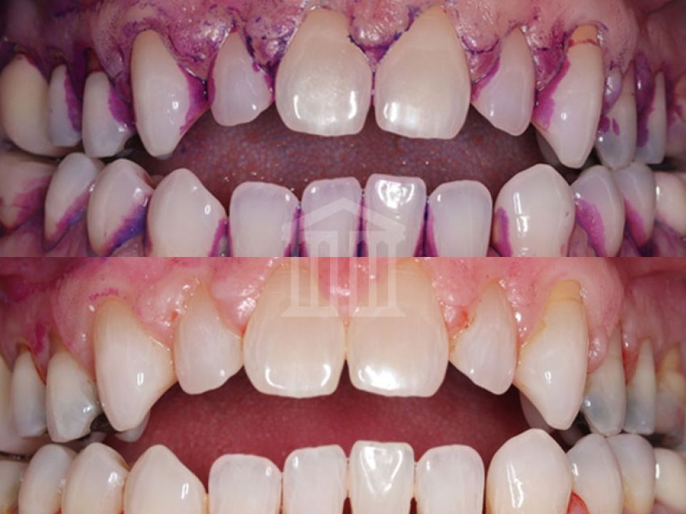 Close-up before and after comparison of teeth showing plaque-stained gums above and cleaner teeth with healthier gums below after a scale and polish.