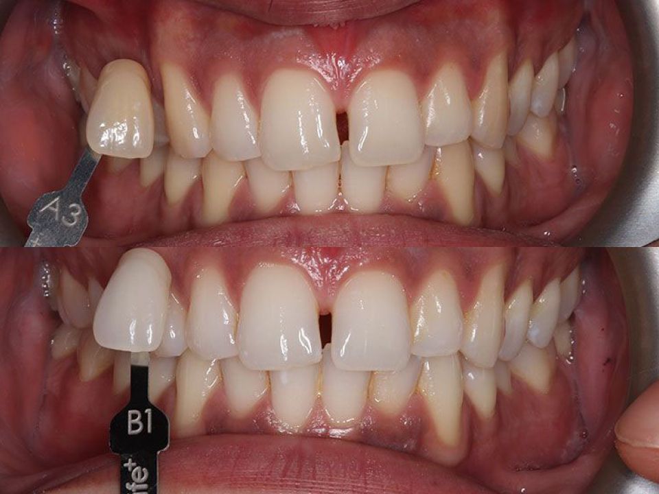 Before and after teeth whitening comparison showing shade guide A3 versus B1, with visibly brighter, whiter teeth post-treatment