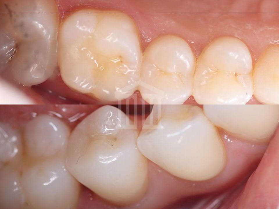 Close-up of upper and lower back teeth with tooth-coloured composite fillings visible on the molar surfaces