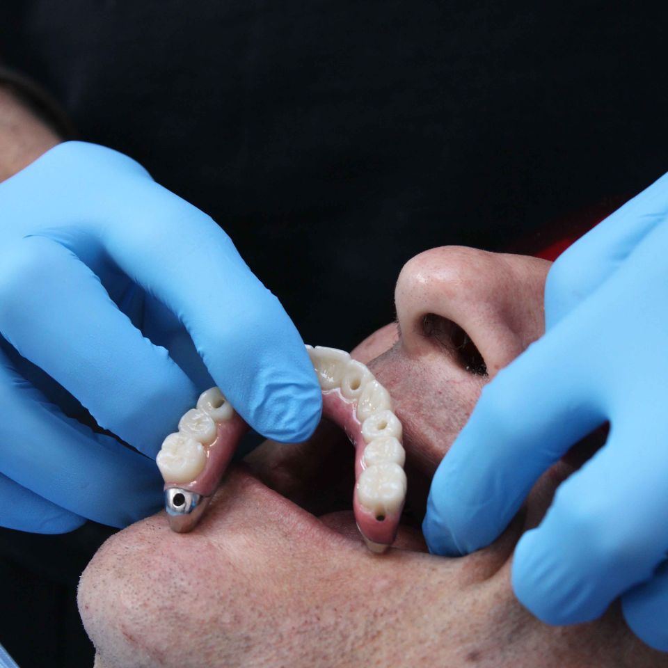 A gloved dentist fitting an All-on-4 dental implant bridge into a patient's open mouth.