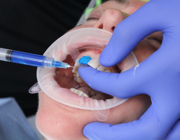 How Often Should You Get a Scale and Polish? Expert Recommendations from Zenith Dental Clinic
