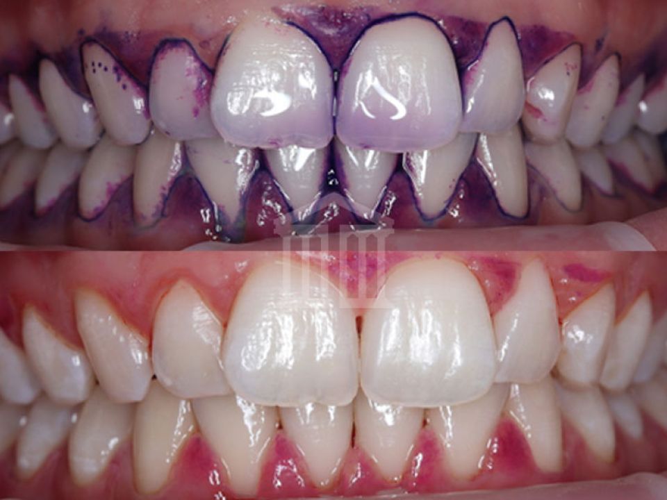 Close-up before and after comparison of teeth following a scale and polish, showing plaque disclosing dye then clean teeth