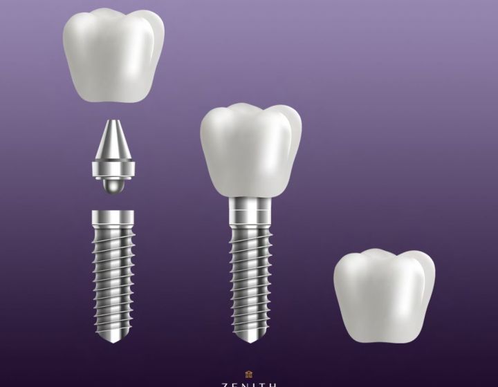 A Zenith Guide to Dental Implants