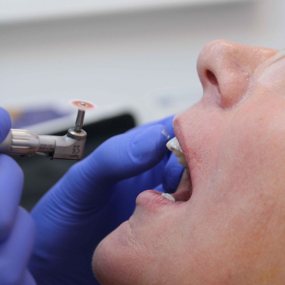 Dentist in blue gloves using a rotary dental tool on a patient's open mouth with visible teeth gaps