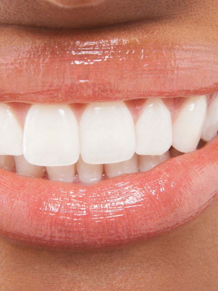 Close-up of a bright smile with perfectly aligned, white teeth and glossy lips