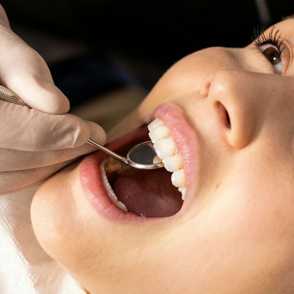 A dentist in latex gloves using a mouth mirror to examine a patient's white fillings during a dental treatment.
