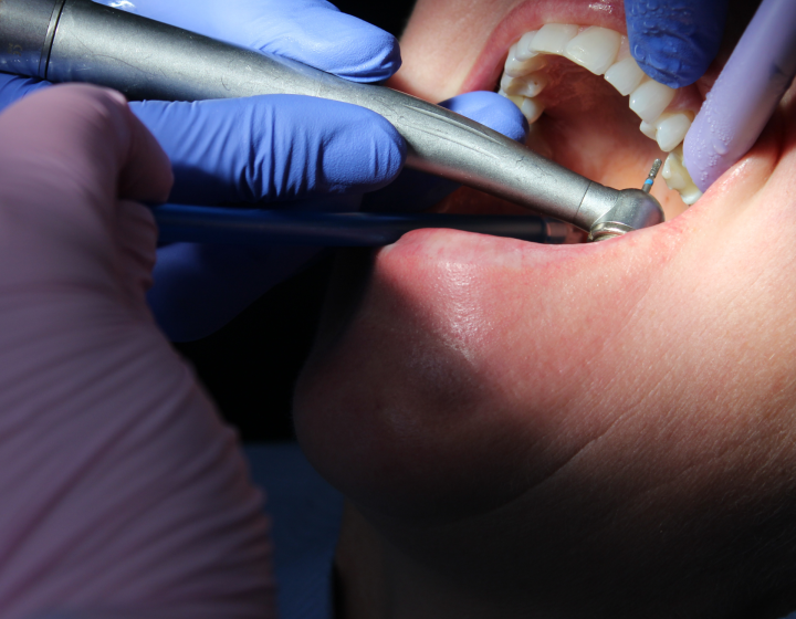 Can Composite Bonding Fix Chipped or Crooked Teeth? Here’s Everything You Need to Know