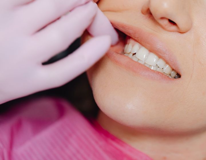 Composite Bonding – Social Media’s Favourite Dental Treatment