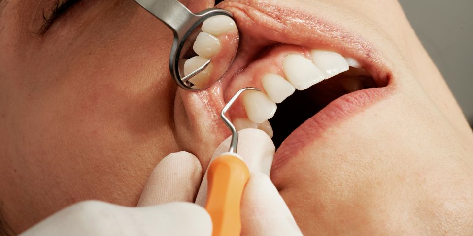Close-up of a dentist using a dental mirror and scaler to examine a patient's teeth during a check-up
