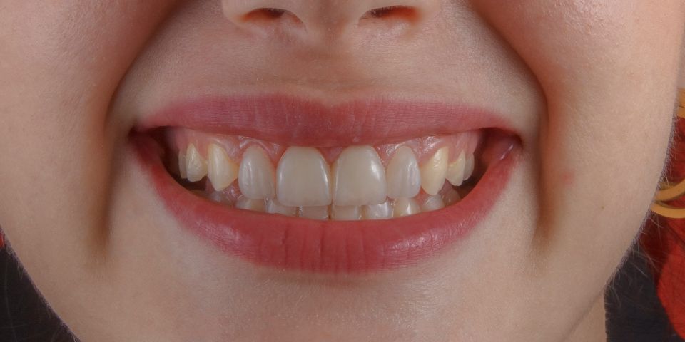 Close-up of a woman smiling, showing her upper and lower teeth with slight natural discolouration