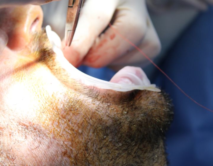 Top 10 Questions to Ask Before Getting Dental Implants
