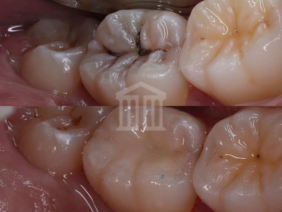 Close-up before and after comparison of molar teeth showing decay treated with tooth-coloured composite fillings