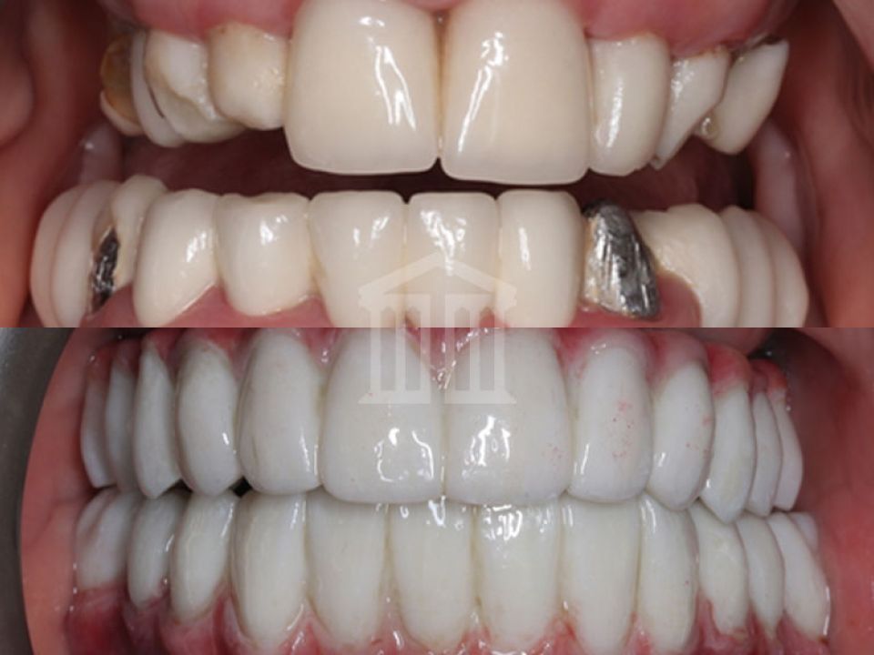 Before and after dental implants showing stained teeth with metal fillings replaced by a full set of bright white uniform teeth