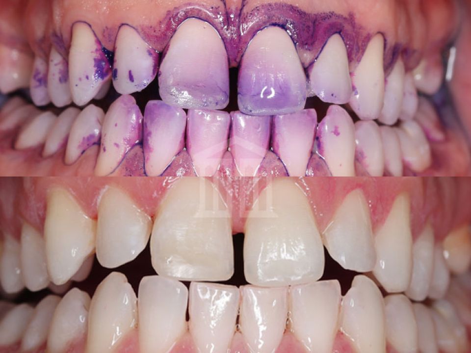 Close-up before and after dental scale and polish, showing plaque-stained teeth above and clean, white teeth below.