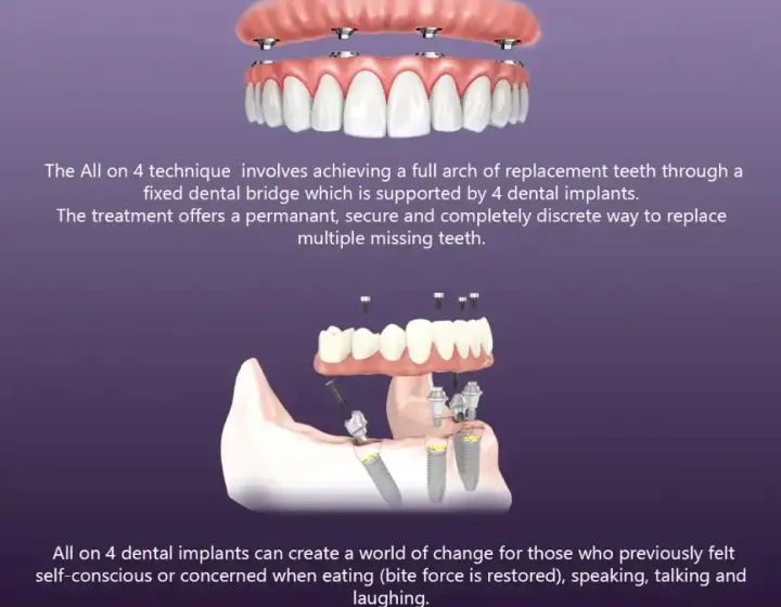 All on 4 Dental Implants – Full Set of Replacement Teeth
